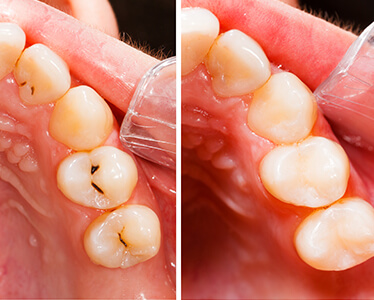 Tooth Cavity Repair