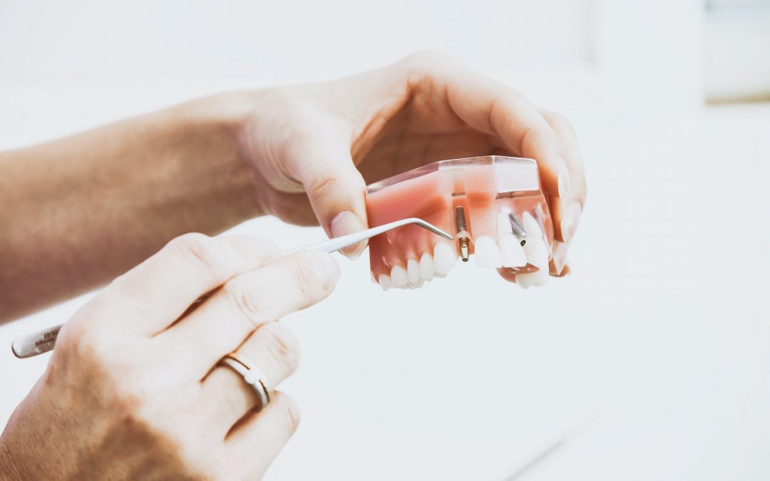 5个种植牙后期护理技巧