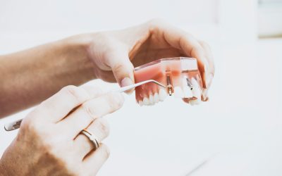 5 Dental Implant Aftercare Tips