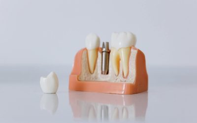 What is the Average Cost of Dental Implants