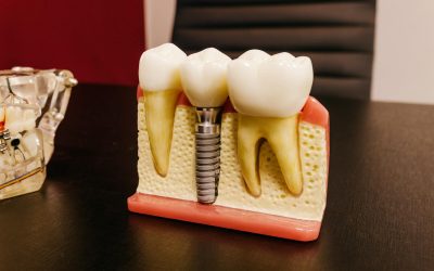 The 7 Most Frequently Asked Questions About Dental Implants in 2022