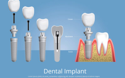 What are the different types of dental implants